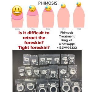 Read more about the article Phimotic Ring Stretching Kit Non Surgical Phimosis Treatment Solution